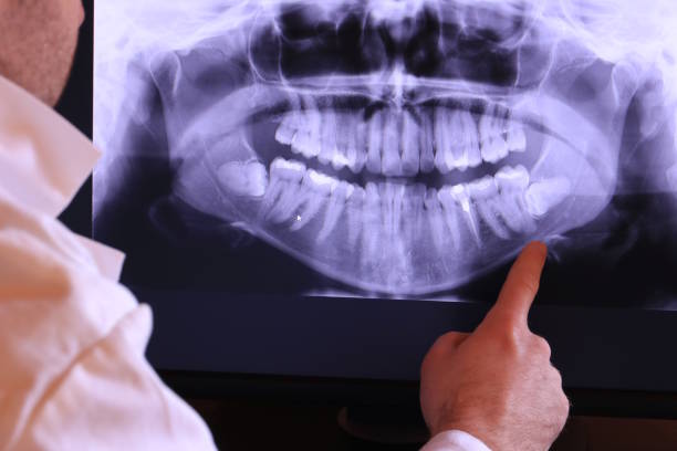 Best Emergency Wisdom Teeth Removal in Muenster, TX